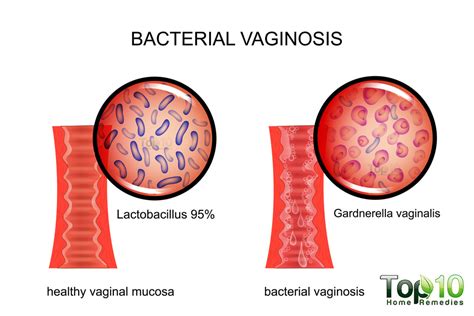 Bacterial vaginosis .
